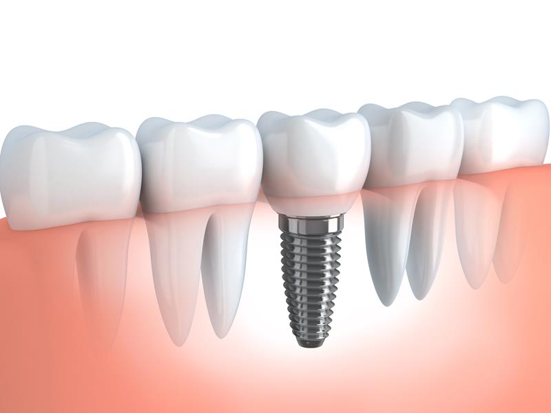Dental Implants  Poway, CA 